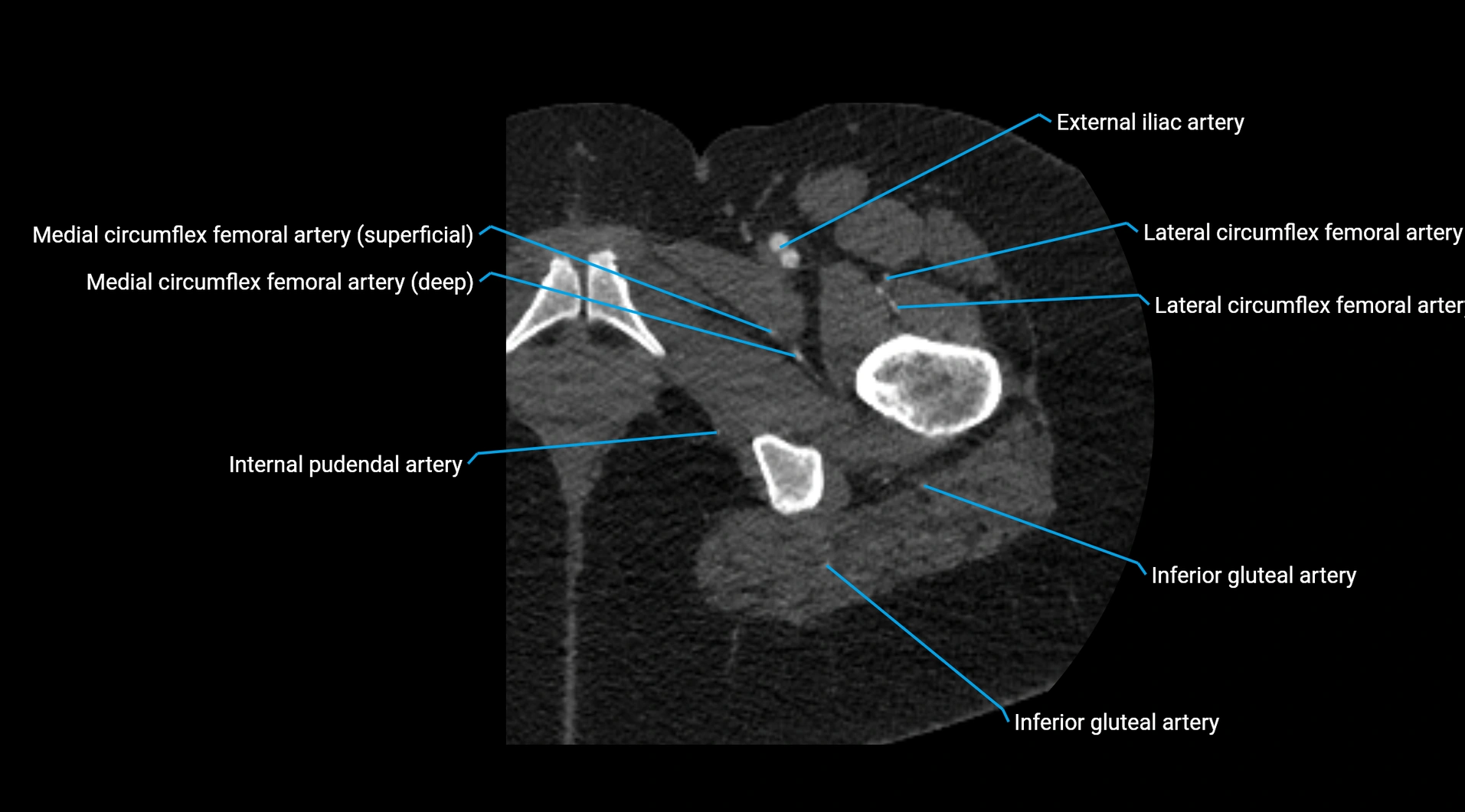 CTA lower limb cross sectional anatomy labelled image _68.webp